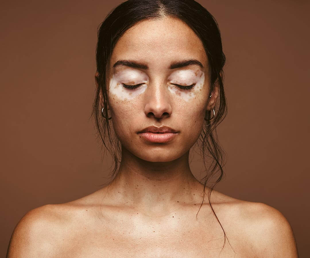 Woman with vitiligo around her eyes before a paramedical micropigmentation appointment.