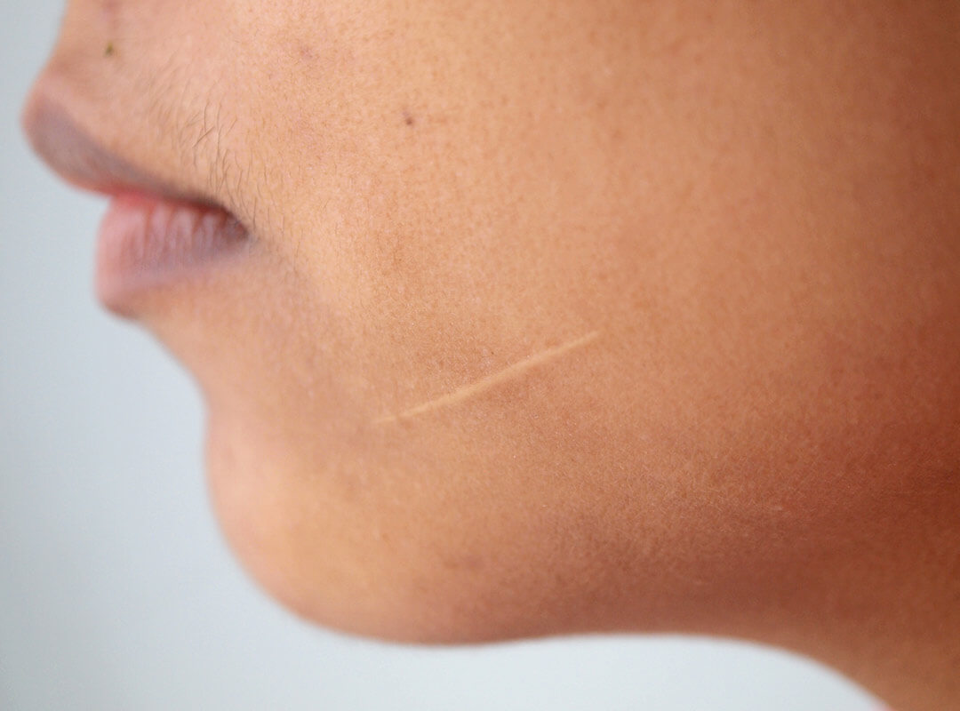 Woman with facial scar, which can be camouflaged with micropigmentation tattoos.